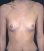 Breast Augmentation