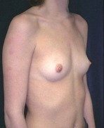 Breast Augmentation