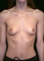 Breast Augmentation Case 2452 Before Photo Breast Augmentation