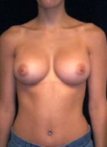 Breast Augmentation Case 2452 After Photo Breast Augmentation