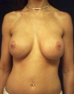 Breast Augmentation Case 2484 After Photo Breast Augmentation