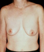 Breast Augmentation Case 2494 Before Photo Breast Augmentation