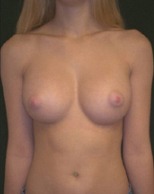 Breast Augmentation Case 2499 After Photo Breast Augmentation