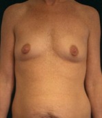 Breast Augmentation Case 2504 Before Photo Breast Augmentation