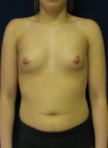 Breast Augmentation Case 2519 Before Photo Breast Augmentation