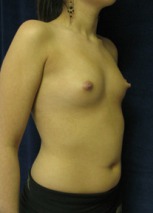 Breast Augmentation Case 2519 Before Photo Breast Augmentation