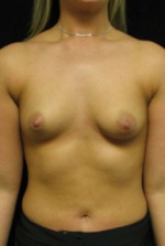 Breast Augmentation Case 2552 Before Photo Breast Augmentation