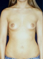 Breast Augmentation Case 2557 Before Photo Breast Augmentation