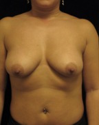 Breast Augmentation