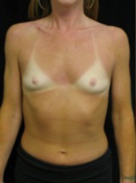 flatten chest of a Woman, Breast Augmentation, Boston MA