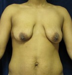 Breast Lift Case 2636 Before Photo Breast Lift