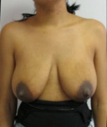 Breast Lift Case 2646 Before Photo Breast Lift