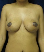 Breast Lift Case 2646 After Photo Breast Lift