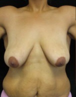 Breast Lift Case 2671 Before Photo Breast Lift