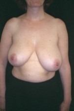 Breast Reduction & Reconstruction