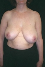 Breast Reduction & Reconstruction Case 2691 Before Photo Breast Reduction & Reconstruction