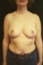 Breast Reduction & Reconstruction