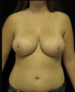 Breast Reduction & Reconstruction