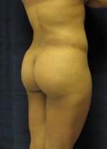 Buttock