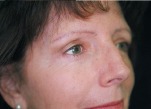 Eyelid Surgery Case 2712 After Photo Eyelid Surgery