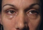 Eyelid Surgery Case 2715 Before Photo Eyelid Surgery