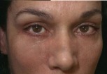 Eyelid Surgery Case 2715 After Photo Eyelid Surgery