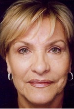 Eyelid Surgery Case 2721 After Photo Eyelid Surgery