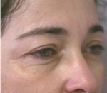 Eyelid Surgery