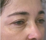 Eyelid Surgery