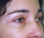 Eyelid Surgery