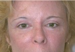 Eyelid Surgery