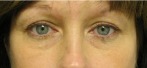 Eyelid Surgery