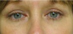 Eyelid Surgery