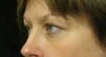 Eyelid Surgery