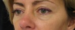 Eyelid Surgery