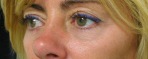 Eyelid Surgery