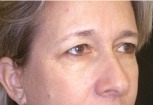 Eyelid Surgery