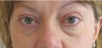 Eyelid Surgery