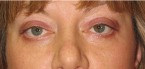 Eyelid Surgery