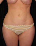 Liposuction Case 2788 After Photo Liposuction