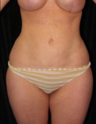 Liposuction