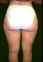 Liposuction