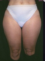 Liposuction