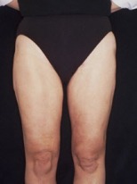 Liposuction