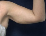 Liposuction Case 2809 Before Photo Liposuction