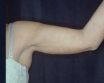 Liposuction Case 2809 After Photo Liposuction