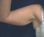 Liposuction Case 2809 Before Photo Liposuction