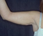 Liposuction Case 2809 After Photo Liposuction