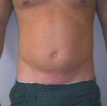 Liposuction Case 2814 Before Photo Liposuction