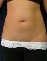 Liposuction Case 2828 Before Photo Liposuction